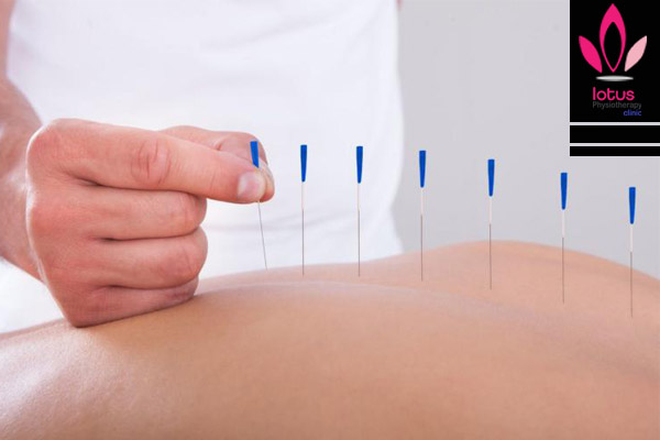 درای نیدلینگ در فیزیوتراپی ، کلینیک فیزیوتراپی لوتوس کارگر شمالی