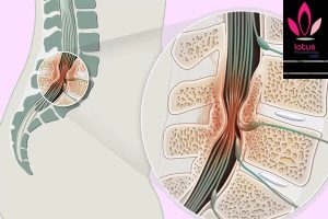 تنگی کانال نخاعی(Spinal Canal Stenosis)/فیزیوتراپی در امیرآباد