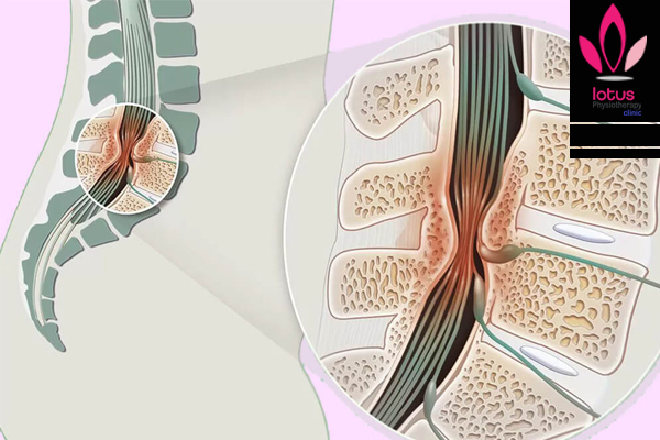 تنگی کانال نخاعی(Spinal Canal Stenosis)/فیزیوتراپی در امیرآباد
