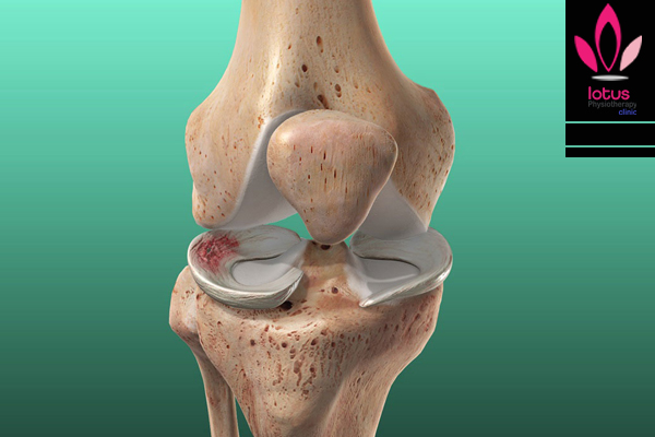 علل و درمان آسیب مینیسک زانو /فیزیوتراپی در امیرآباد