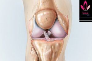 علل و درمان آسیب تاندون صلیبی قدامی زانو (ACL) /فیزیوتراپی در امیرآباد