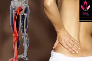 سیاتیک و علائم آن / فیزیوتراپی در امیرآباد