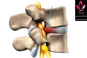 فتق دیسک کمری چیست؟/فیزیوتراپی در امیرآباد